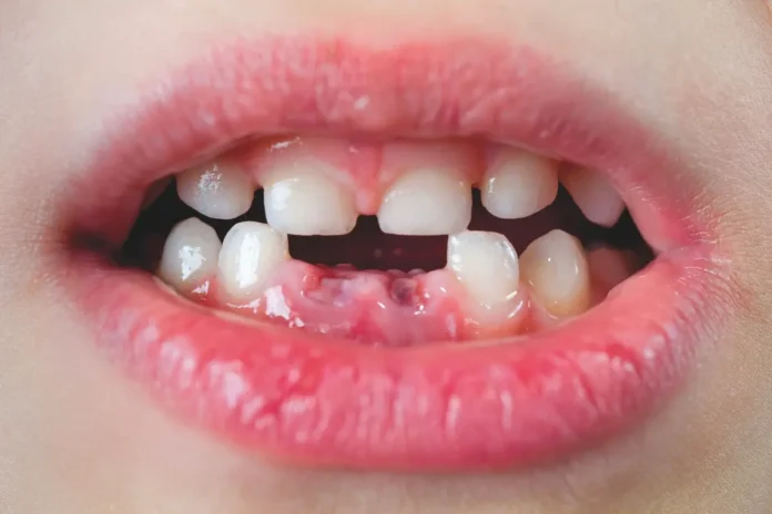 Bei Hypophosphatasie, einer seltenen Krankheit, werden die Knochen weich.