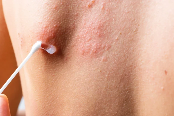 Gürtelrose-Impfung: Bis zu 90 % Schutz für Menschen über 60