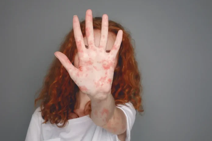 Person mit lockigem rotem Haar hält eine Hand mit roten Hautflecken vor das Gesicht.