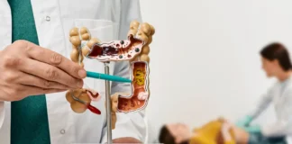 Modell des Darms mit Darstellung von Tumoren zur Veranschaulichung der Metastasierung bei Darmkrebs