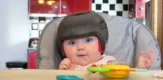 Säugling mit medizinischem Helm zur Behandlung einer Kraniosynostose
