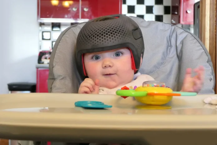 Säugling mit medizinischem Helm zur Behandlung einer Kraniosynostose