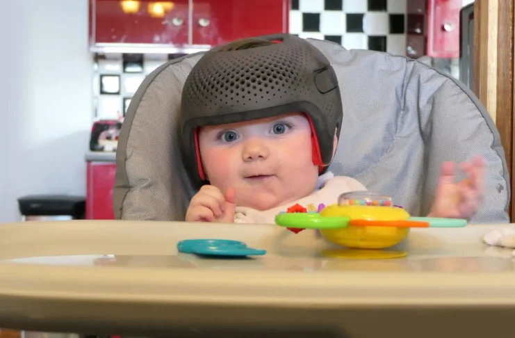 Säugling mit medizinischem Helm zur Behandlung einer Kraniosynostose