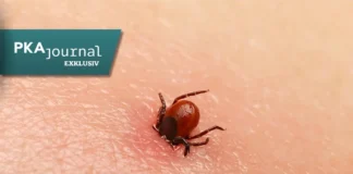 Zecke auf menschlicher Haut als Überträger von FSME und Borreliose