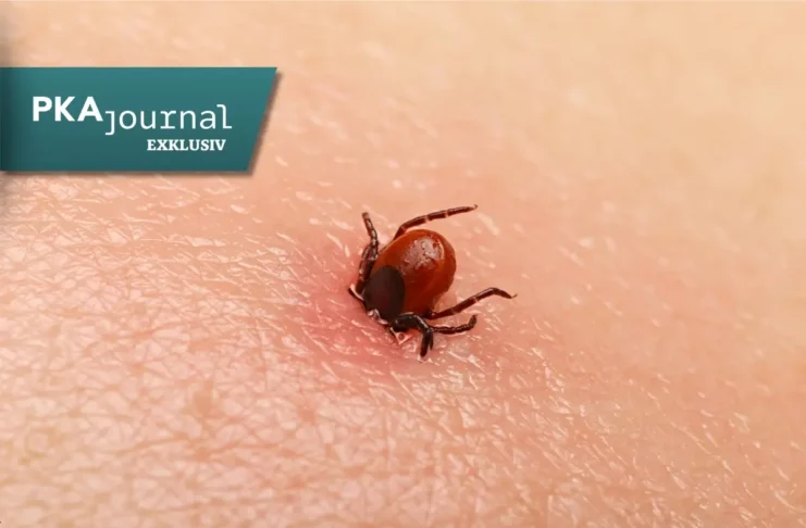 Zecke auf menschlicher Haut als Überträger von FSME und Borreliose