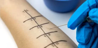 Pricktest am Unterarm zur Untersuchung allergischer Sensibilisierungen im Rahmen einer Allergiestudie