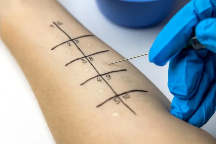 Pricktest am Unterarm zur Untersuchung allergischer Sensibilisierungen im Rahmen einer Allergiestudie