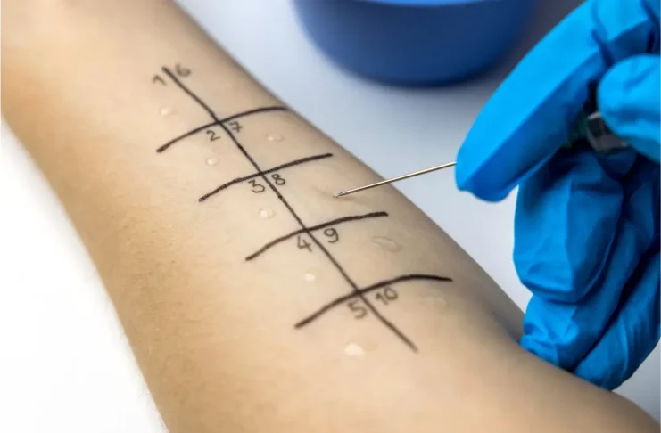 Pricktest am Unterarm zur Untersuchung allergischer Sensibilisierungen im Rahmen einer Allergiestudie