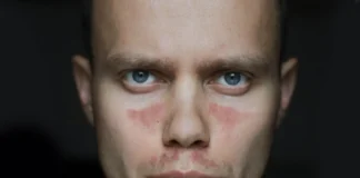 Mann mit typischen Hautveränderungen bei systemischem Lupus erythematodes (SLE), für den der Antikörper Dapirolizumab Pegol untersucht wird.