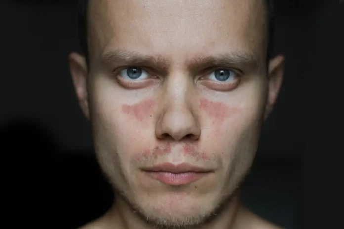 Mann mit typischen Hautveränderungen bei systemischem Lupus erythematodes (SLE), für den der Antikörper Dapirolizumab Pegol untersucht wird.