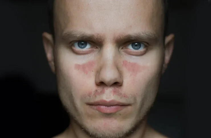 Mann mit typischen Hautveränderungen bei systemischem Lupus erythematodes (SLE), für den der Antikörper Dapirolizumab Pegol untersucht wird.