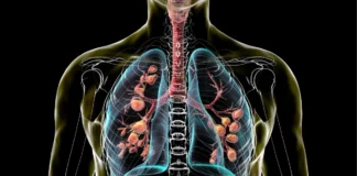 Illustration der Lunge bei Mukoviszidose. Moderne CFTR-Modulatoren verbessern die Lebenserwartung von Menschen mit zystischer Fibrose.
