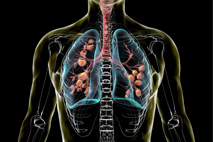 Illustration der Lunge bei Mukoviszidose. Moderne CFTR-Modulatoren verbessern die Lebenserwartung von Menschen mit zystischer Fibrose.