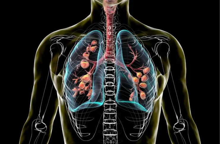 Illustration der Lunge bei Mukoviszidose. Moderne CFTR-Modulatoren verbessern die Lebenserwartung von Menschen mit zystischer Fibrose.