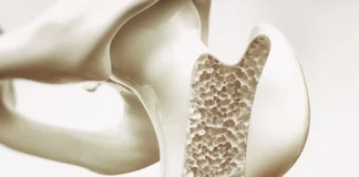 Querschnitt eines porösen Knochens als Illustration von Osteoporose und verminderter Knochendichte.