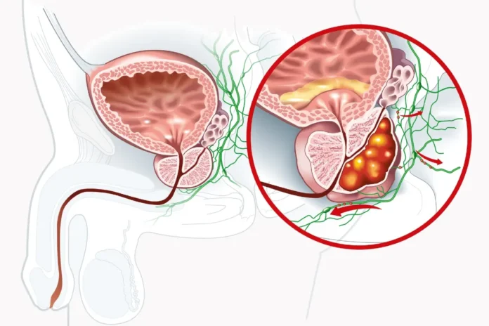 Schematische Darstellung eines Prostatakarzinoms mit Ausbreitung in der Prostata und Lymphbahnen.