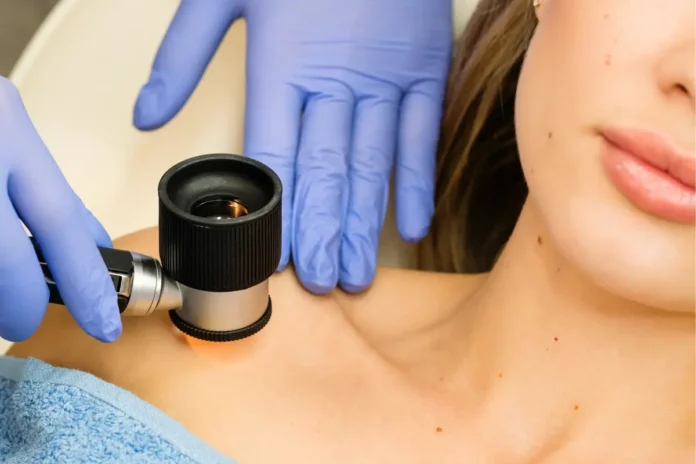 Dermatologische Untersuchung eines Muttermals mit einem Dermatoskop zur Früherkennung von weißem Hautkrebs.