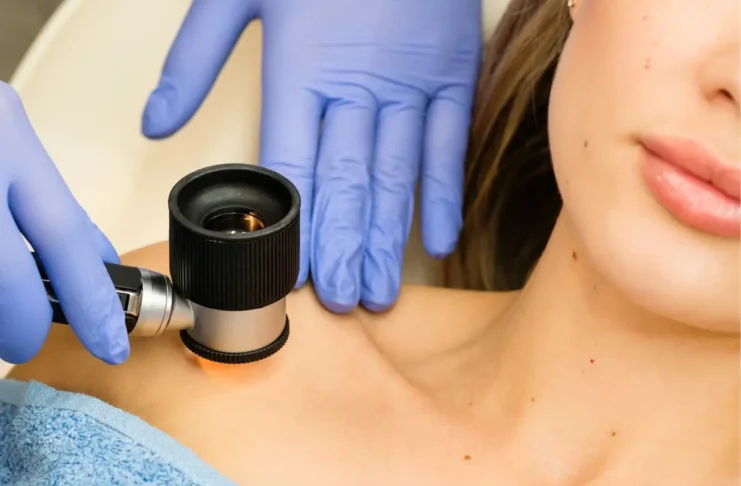 Dermatologische Untersuchung eines Muttermals mit einem Dermatoskop zur Früherkennung von weißem Hautkrebs.