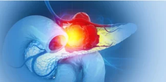 Medizinische Darstellung einer Bauchspeicheldrüse mit Tumor