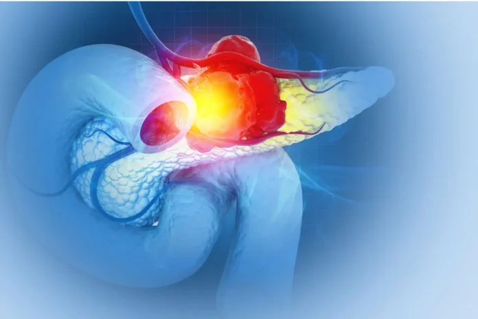 Medizinische Darstellung einer Bauchspeicheldrüse mit Tumor