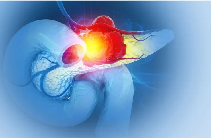 Medizinische Darstellung einer Bauchspeicheldrüse mit Tumor