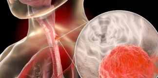 Medizinische Illustration eines Tumors in der Speiseröhre mit vergrößerter Darstellung des Krebsgewebes.