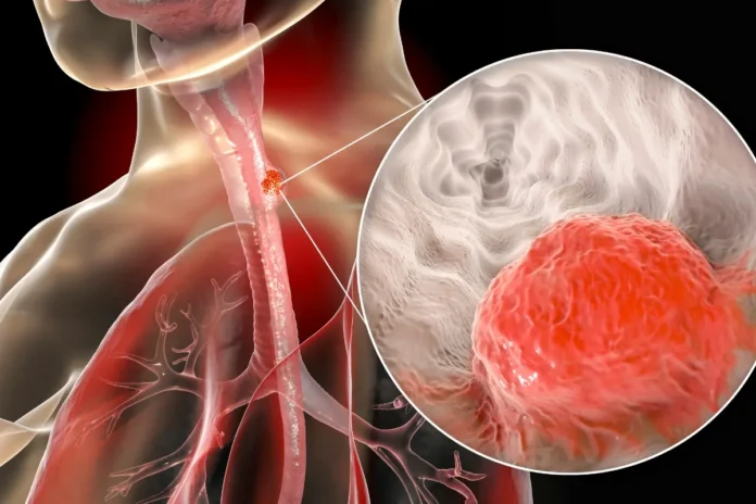 Medizinische Illustration eines Tumors in der Speiseröhre mit vergrößerter Darstellung des Krebsgewebes.