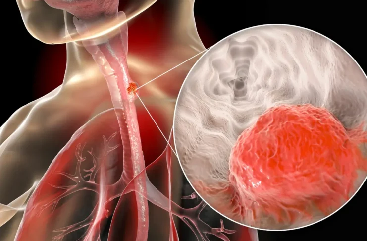 Medizinische Illustration eines Tumors in der Speiseröhre mit vergrößerter Darstellung des Krebsgewebes.